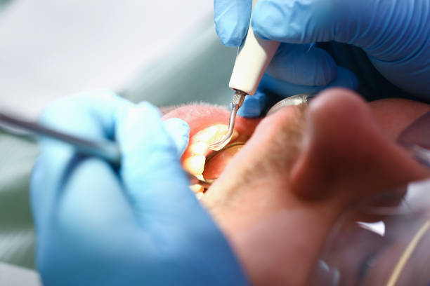 Teeth Whitening in NY